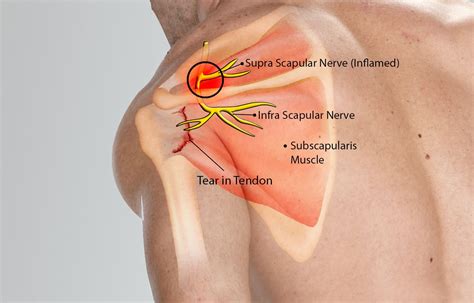 Scapular Nerve Impingement Symptoms - Dermatomes Chart and Map