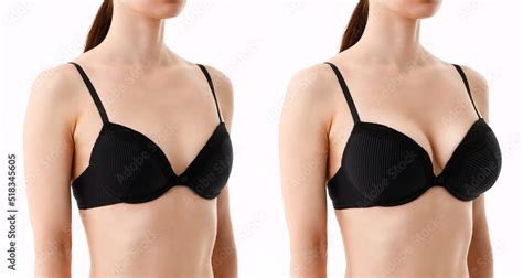 breast augmentation