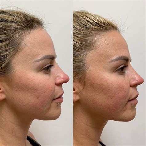PDO Thread Lift in Newport Beach, CA | Beauty Boost Med Spa