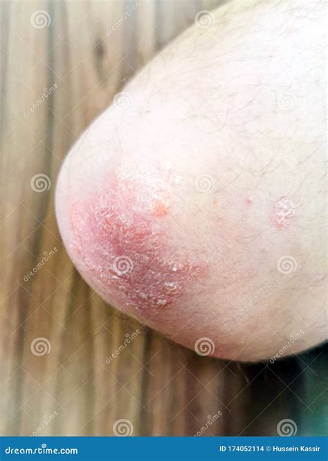 Skin With Psoriasis Stock Photo | CartoonDealer.com #18964878