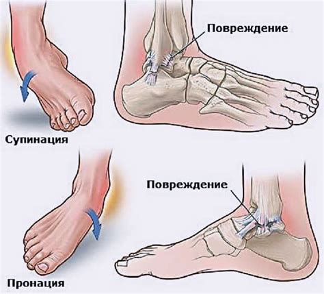 Гематома на ноге после ушиба, лечение синяков на ногах без ударов
