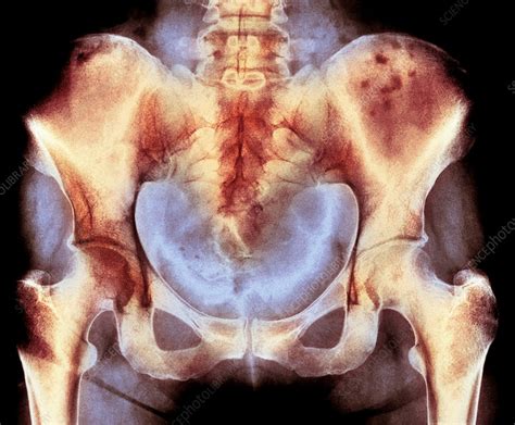 bone marrow cancer  ray stock image  science photo library