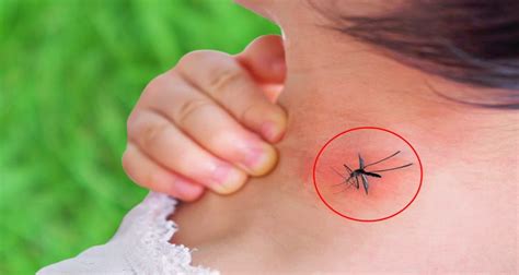 Dengue Symptoms - What Are The Symptoms Of Dengue Fever?