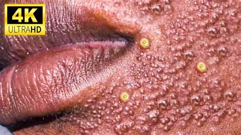 Unbelievable Blackhead Removal 2024: The Ultimate Guide to Poreless Skin - 6b6aqo1