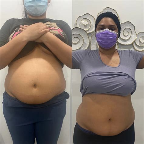 Body Contouring Vancouver | 3D LifeStyle