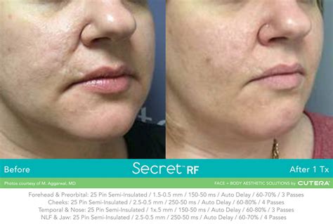 Secret RF Chicago | RF Acne Scar Treatment — Cordial Medical Spa