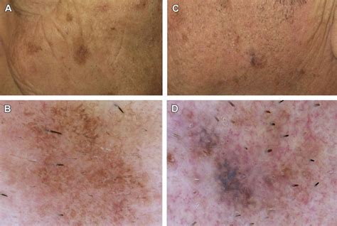 Problematic Lesions in the Elderly - Dermatologic Clinics