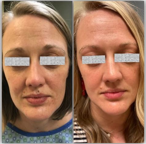 Procell Micro Channeling - Flatirons Dermatology