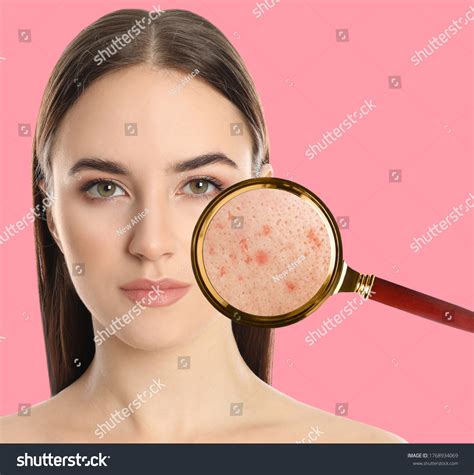 1 Young Woman Acne Problem On Pink Background Skin Under Magnifying