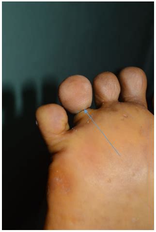 case  solitary pseudo ainhum     toe   university