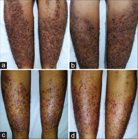 Vesicular lesions in lichen amyloidosis - Indian Journal of Dermatology, Venereology and Leprology