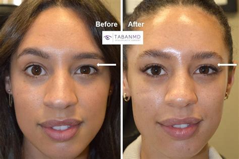 how to fix uneven eyelids in the morning