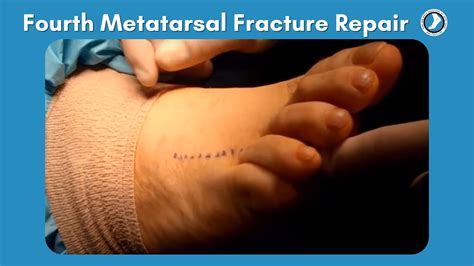 Metatarsal fracture treatment - buildingsery