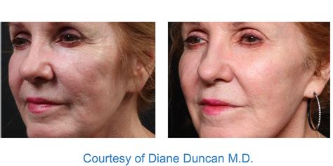 exion treatment exion    results reviews