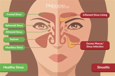 Sinus Infections: Causes, Symptoms & Natural Support Strategies