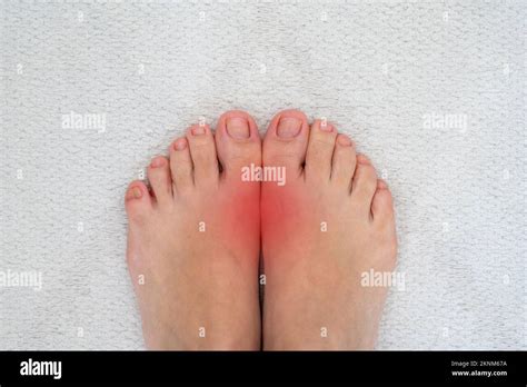 feet disease rheumatism  gout painful gout inflammation  big toe
