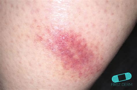 Skin Rash Caused By Bug Bites at Amy Ammerman blog