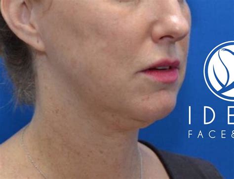 face  neck lift archives ideal face  body