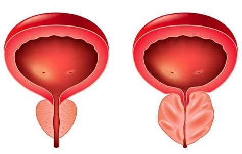 Prostate Cancer | Owensboro Health