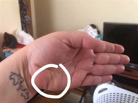 Hello, this spot on my hand has gotten worse over the past two years. I