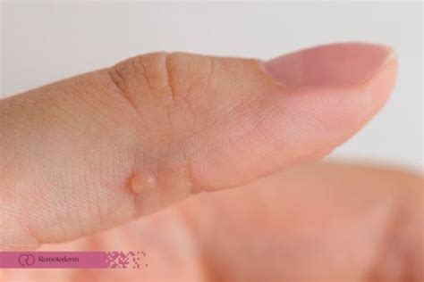 Phymatous Rosacea Treatments, Causes, Symptoms - RemoteDerm
