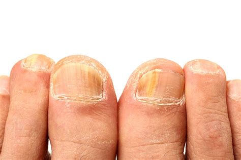 nail bed infection skin  bruce moreno blog