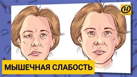 Лечение миастении: методы, препараты, противопоказания при болезни