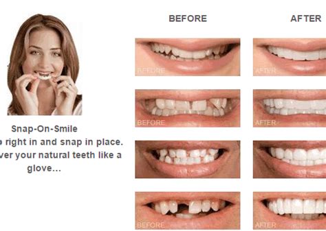 Snap on smile Beverly Hills doctor | Call (310) 596-4177