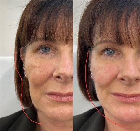 jawline filler  comprehensive guide