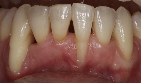 Orthodontic Wire Removal at Melody Hanks blog