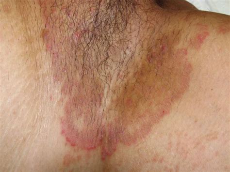 decoding skin rashes unveiling  culprits   itch nextmed