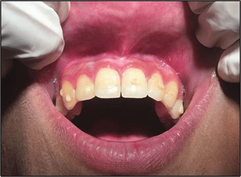 Labial Frenulum Normal