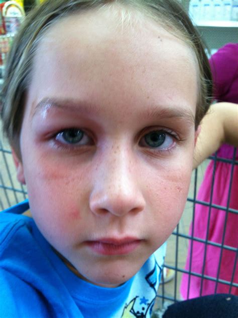 Tommi's wasp sting. :0( | Wasp stings, Twin mom, Wasp