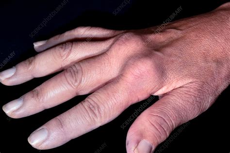 Hand in CREST syndrome - Stock Image - C034/5431 - Science Photo Library