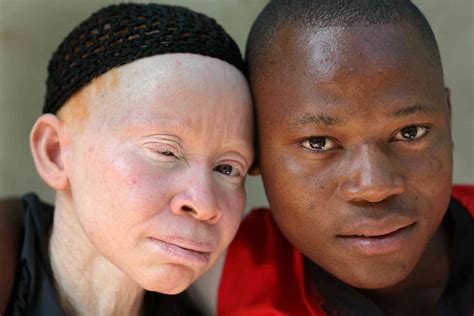 Ser una persona con albinismo no es igual en Europa que en África