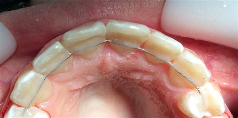Как работает ретейнер и зачем он нужен? - Dentist-Club
