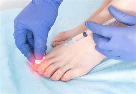 The doctor makes an injection in the joint of the toe for arthrosis