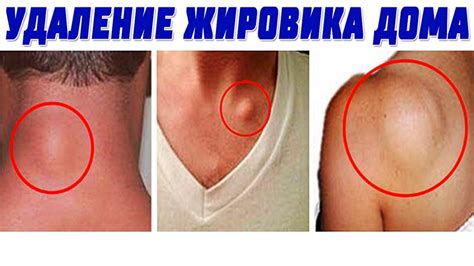 Эффективное Удаление ЛИПОМЫ [ЖИРОВИКА] на Коже, в Домашних Условиях ...