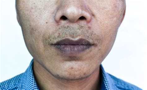 cyanotic lips  central cyanosis  southeast asian man stock image