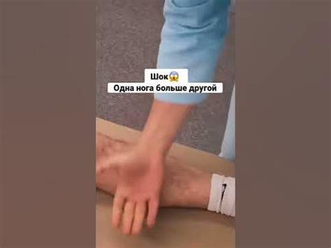 Нога короче другой😱 | Разная длина ног, одна нога больше другой # ...