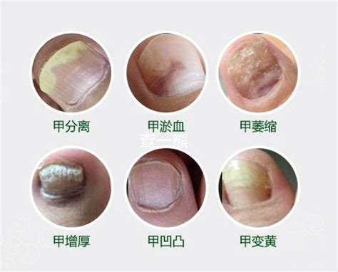 【灰指甲手册】灰指甲你必须知道的那些事 - 知乎
