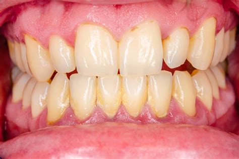 Gingivitis Vine at Andrew Gillan blog