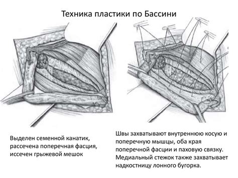 Паховые грыжи - презентация онлайн