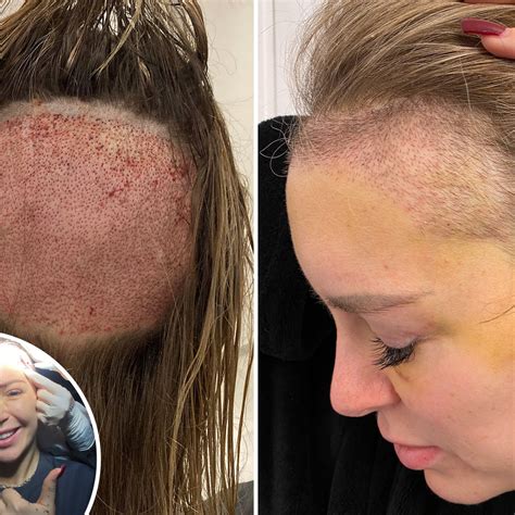 Can Women Have Hair Transplants? - Classified Mom