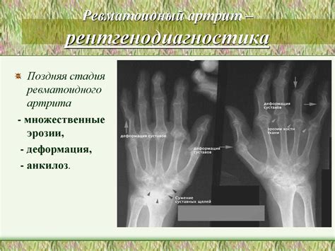 Сестринский процесс при ревматоидном артрите, деформирующем ...
