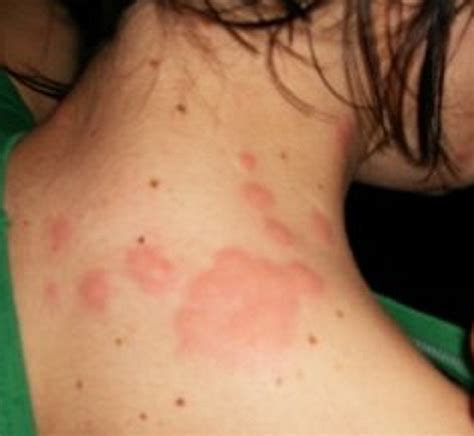 BED BUG BITES | BED BUG BITES PICTURES, TREATMENT and SYMPTOMS