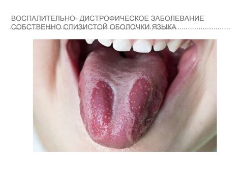 Десквамативный глоссит - online presentation