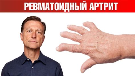 Ревматоидный артрит - лечение народными средствами