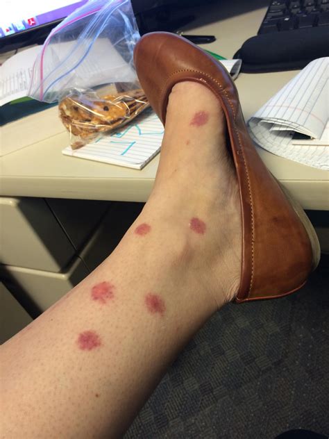 Mosquito Bite Allergic Reaction