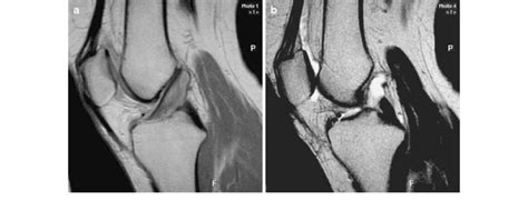 a Sagittal T1 view of the ACL by MRI. Mucoid degeneration of the lower... | Download Scientific ...